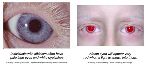 Albino eyes will appear very red when a light is shown into them ...