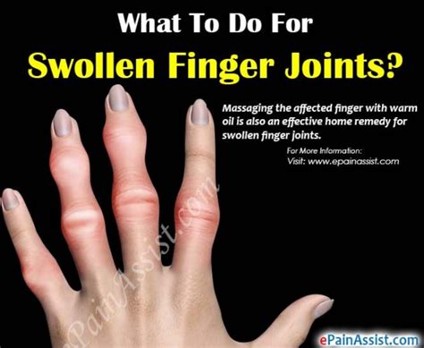 How To Reduce Swelling Of Ring Finger - Duane Pickrell Kapsels