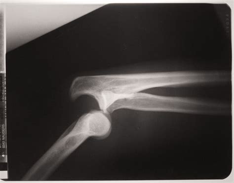 X-Ray With Dislocated Arm Joints | Copyright-free photo (by M. Vorel ...