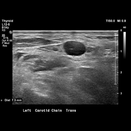 Swollen Lymph Nodes In Neck Ultrasound