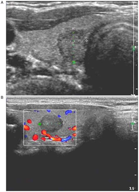 Thyroid Ultrasound Cancer