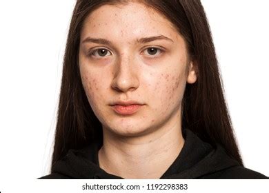 Pimple Girl Photos, Images & Pictures | Shutterstock