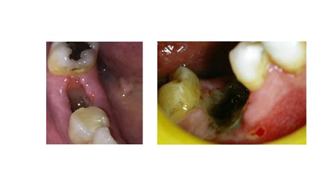 Dry Socket: The Most Common Complication After Tooth Extraction