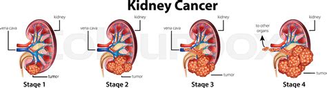 Diagram showing different stages of kidney cancer | Stock vector ...