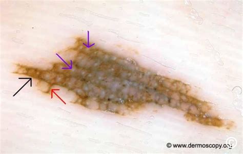 Acral-lentiginous melanoma