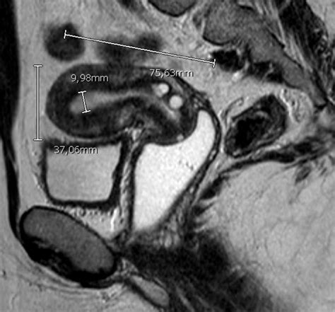 Pelvic magnetic resonance image T2 high resolution, sagittal anteverted ...