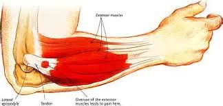 Lateral Epicondylitis | Musculoskeletal Treatment