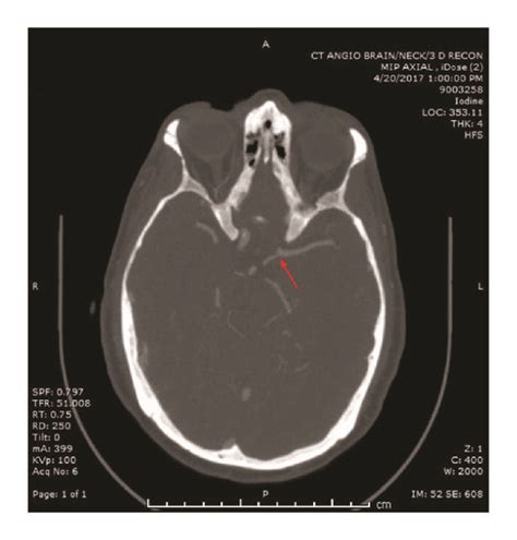 CT angiogram head and neck (continued): note the absence of the left ...