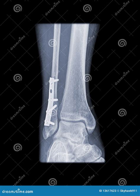 Fixed Weber B Fracture Stock Photos - Image: 13617623