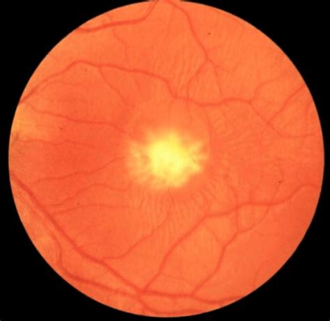 Vitelliform macular dystrophy: MedlinePlus Genetics