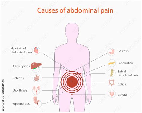 Causes of abdominal pain, vector, medical diagram Stock Vector | Adobe ...