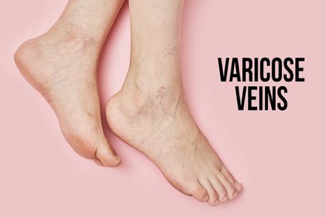 Main Causes of Varicose Veins - Top Varicose Vein Treatment NYC