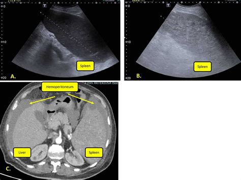 Spleen peliosis, causes, signs, symptoms, diagnosis & treatment