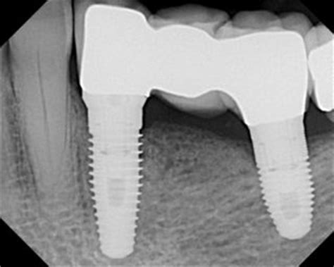 4-Tooth Bridge Failure – Dental Implant Bridge Replacement | Ramsey A ...