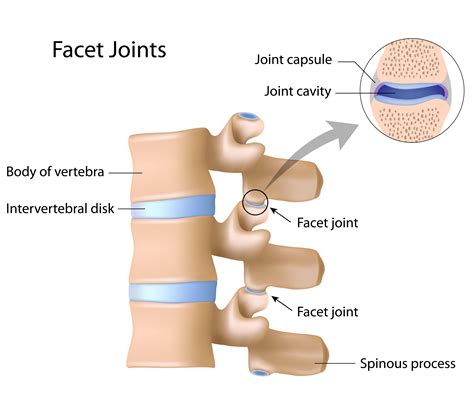 Facet Arthropathy Causes, Symptoms & Treatments