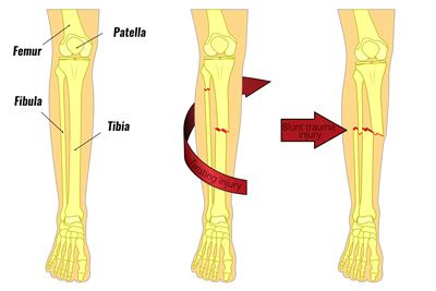 Fibula Fracture - Types, Symptoms, Causes and Rehabilitation