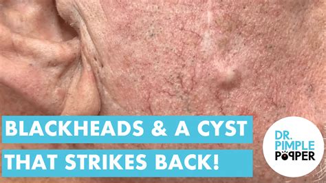 BLACKHEADS & The Cyst that Strikes Back - Bedtime Blackheads - Dr ...