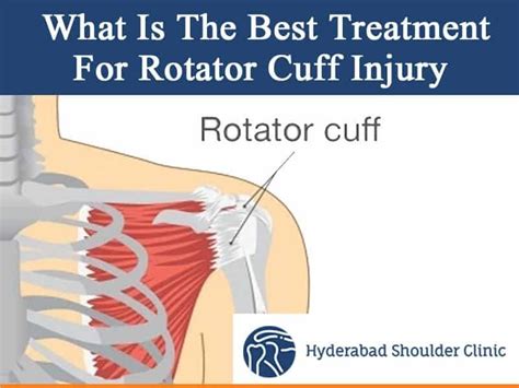 Rotator Cuff Injury Including Rotator Cuff Tear, Rotator Cuff Bursitis ...