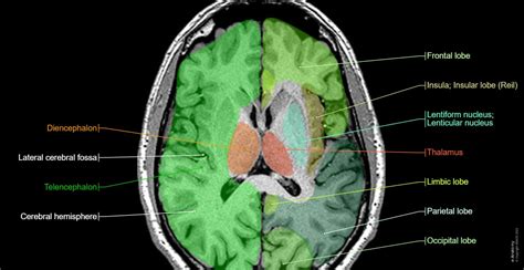 Brain Lobes Labeled Mri at Harold Cook blog