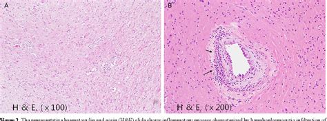 Figure 2 from Primary Angiitis of the Central Nervous System Presenting ...