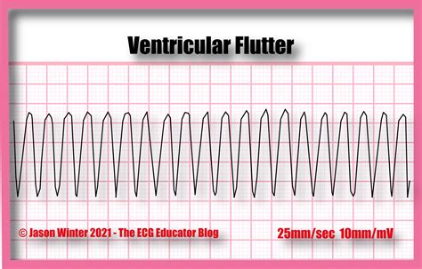 Ventricular Flutter Vs Fibrillation