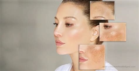 Melasma Treatment: Choose Right Approach in 3 Simple Tips