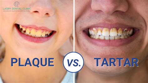 Plaque vs. Tartar and How To Remove Them At Home