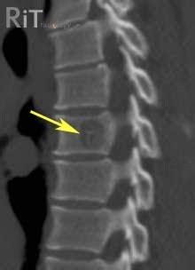 RiT radiology: Spinal Hemangioma