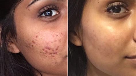 Controversial Cystic Acne Routine Goes Viral — Before-and-After Photos ...