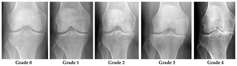 X-ray Stages Of Knee Arthritis