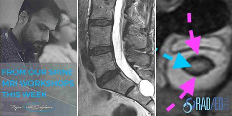 SPINE FACET JOINT MRI ONLINE RADIOLOGY COURSES: KEY POINTS FROM OUR ...