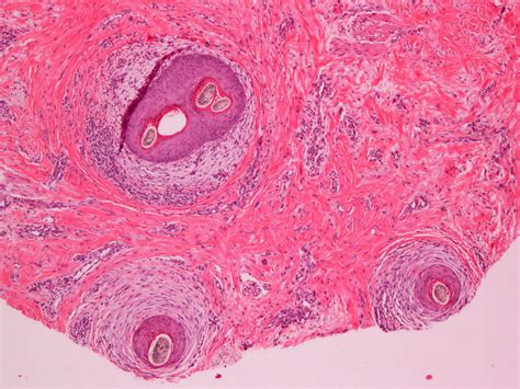 Scarring Alopecia Histology