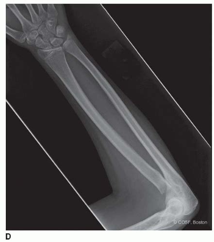 Congenital Radial Head Dislocation | Musculoskeletal Key