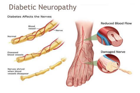 Diabetic Neuropathy - Center for Advanced Cardiac and Vascular ...