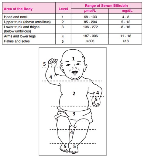 Chart For Jaundice Levels In Newborns Newborn Jaundice Bilir