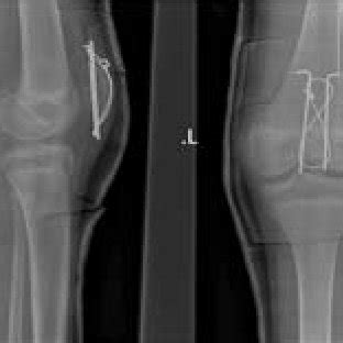 (PDF) Sleeve Fracture of the Patella in Children