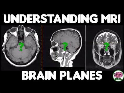 Mri Images Of The Brain