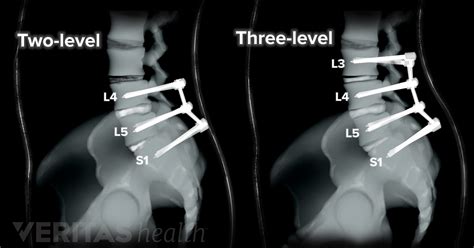 Spinal Fusion Surgery L5 S1