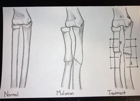 Malunion of Bone – Human STEAM