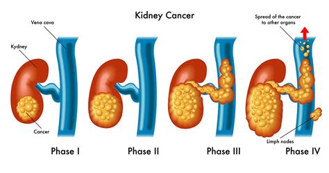 Kidney Cancer - Sunrise Urology