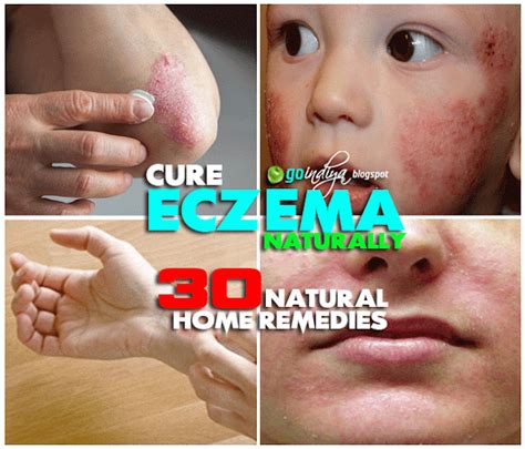 30 Natural Home Remedies for Eczema (Atopic dermatitis) in Kids ...