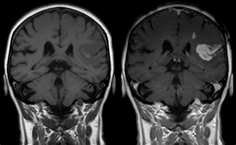 MRI With and Without Contrast Explained | AffordableMRI.com