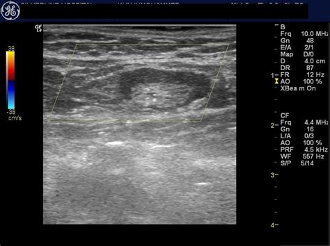 Swollen Lymph Nodes In Neck Ultrasound