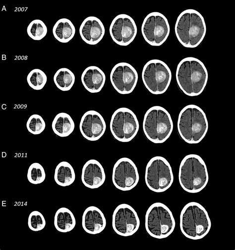 Size Of Meningioma Tumor | Hot Sex Picture