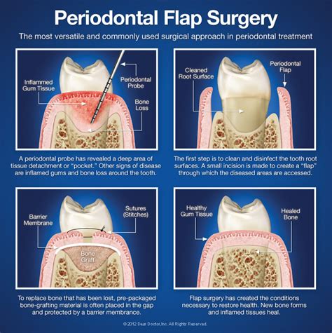 periodontal-flap-surgery.jpg | Keystone Mini Dental Implant Center ...