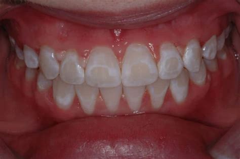 Teeth Have White Spots? What Can Be Done? - McOmie Dentistry Chattanooga