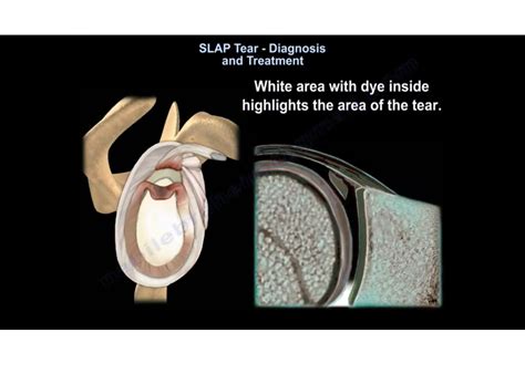 SLAP Tear Diagnosis and Treatment — OrthopaedicPrinciples.com