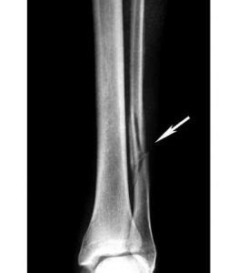 Fibula Fracture - Types, Symptoms, Causes and Rehabilitation