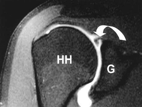 Superior Labral Anteroposterior Tear: Classification And, 59% OFF