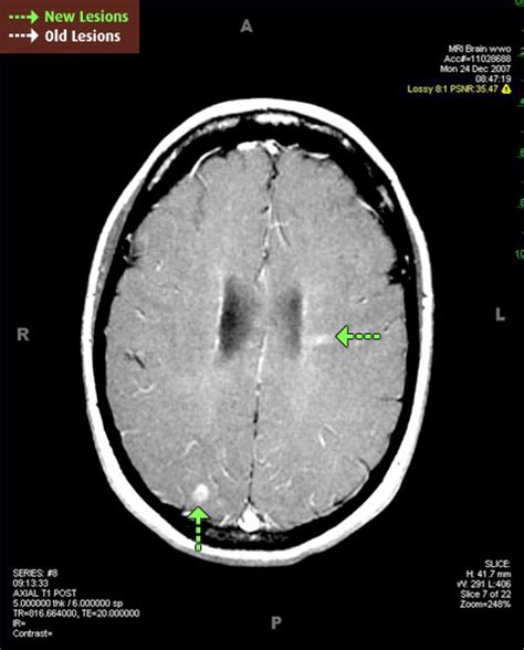 Ms Brain Mri With Contrast